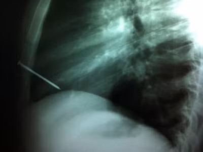Đinh 8 cm đâm vào tim vẫn sống
