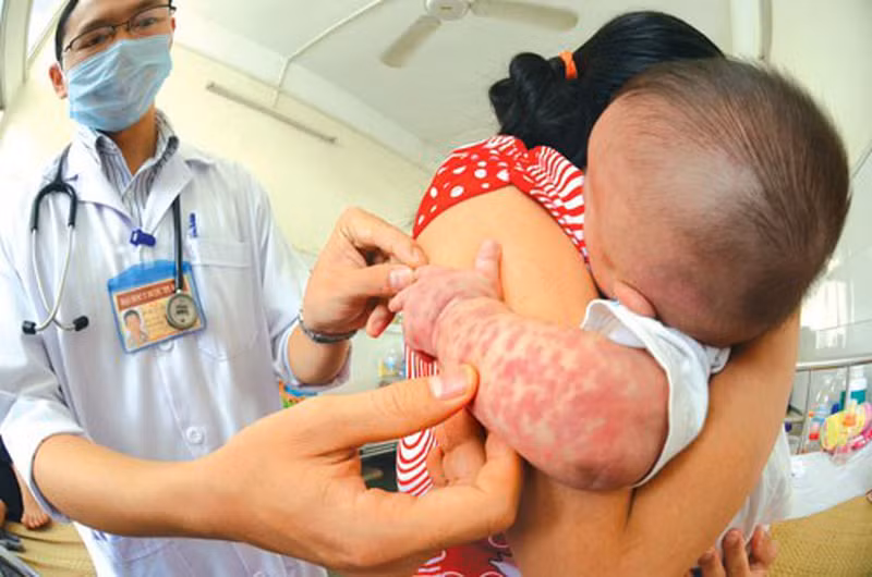 Ban sởi mọc theo thứ tự bắt đầu ngày thứ nhất từ đầu, mặt, cổ. Ngày thứ 2 mọc ở ngực lưng, cánh tay. Ngày thứ 3 mọc ở bụng, mông, đùi, chân. Khi ban mọc tới chân hết sốt và ban bắt đầu bay. Ảnh: Internet