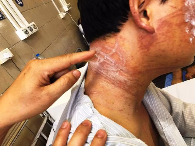 Các vết thương vẫn chằng chịt trên cơ thể người đàn ông sau 10 ngày bị sứa tấn công.