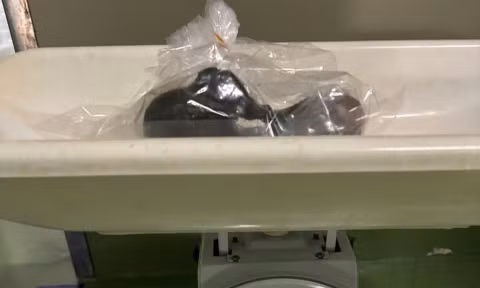Bé gái 5 tuổi có khối tóc 'khủng' trong bụng, do ăn tóc