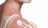 Nắng nóng cực điểm: Cảnh báo bỏng nắng và bệnh da tăng cao