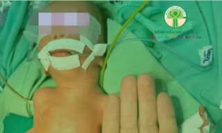‘Nhường’ máu nuôi người anh song thai, bé trai sinh non nguy kịch