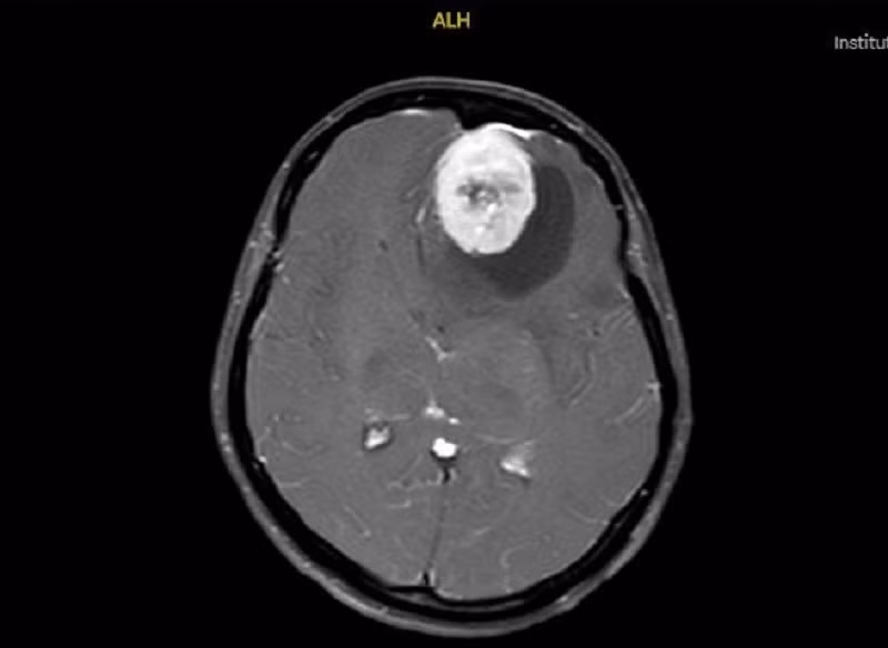 hinh-u-nao-tren-phim-mri.jpg