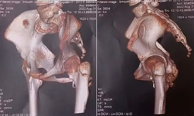 Phát hiện bé gái mắc hội chứng 'người hóa đá' cực hiếm