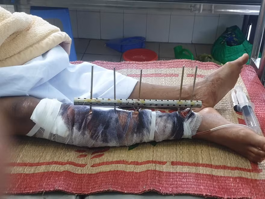Ngư dân Đỗ Đức Long bị tấn công gãy dập chân và đa chấn thương vùng đầu.