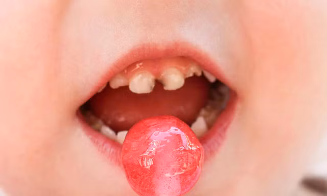 Tầm quan trọng của răng sữa, điều ít mẹ biết