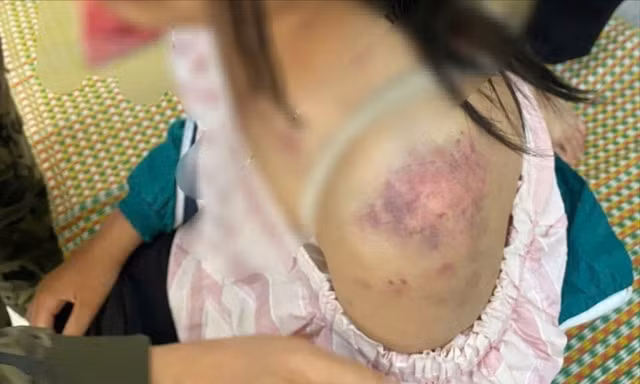 Bé gái 13 tuổi bị bà nội và hai người ông tra khảo, đánh đập dã man vì nghi trộm tiền 