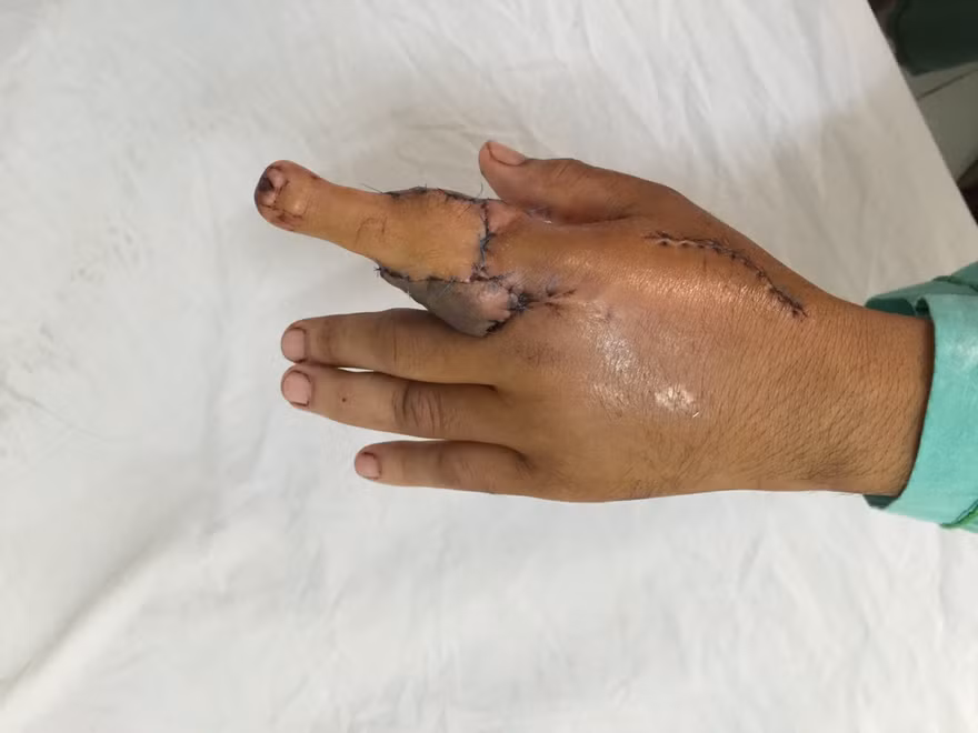 Bàn tay trái bệnh nhân sau khi được ghép ngón chân thay thế ngón trỏ bị cụt. Ảnh do bệnh viện cung cấp.