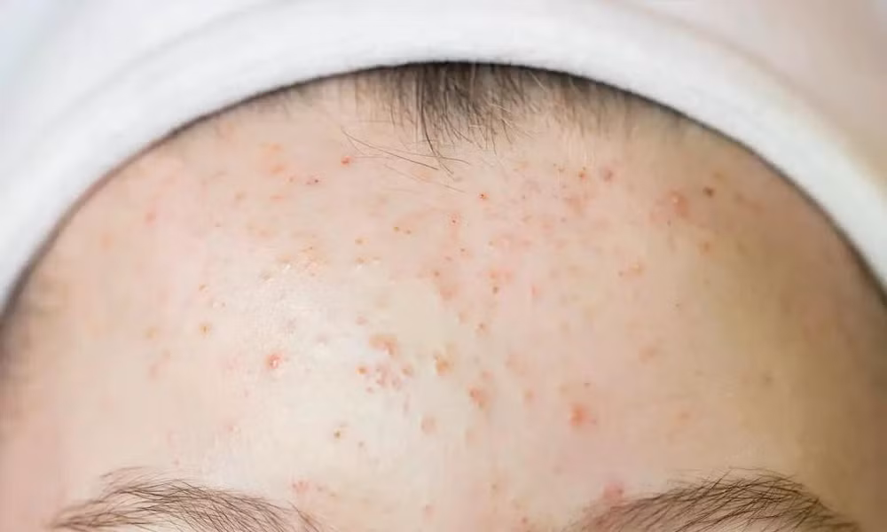 Thủ phạm gây ra mụn trên trán và cách ngăn chặn chúng hiệu quả