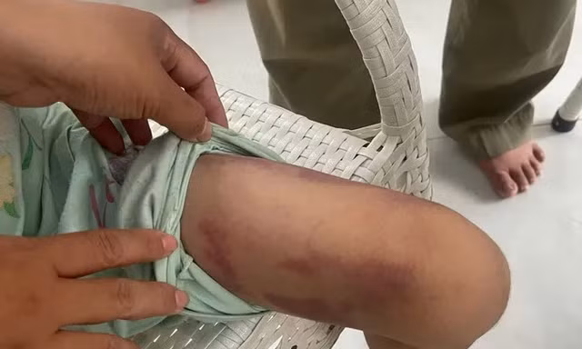 Bé gái 9 tuổi bị mẹ ruột cùng người tình đánh dã man trong phòng trọ 