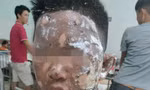 Tự mua thuốc nổ trên mạng về chế pháo, nhiều trẻ bị trọng thương