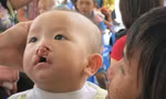 Mỗi năm, hàng nghìn trẻ chào đời bị dị tật hàm mặt