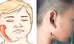 BS Trương Hữu Khanh nói về căn bệnh bị gọi tên 'vi khuẩn ăn thịt người'