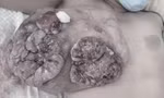 Trì hoãn điều trị để sinh con, người mẹ mất một bên ngực