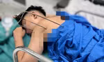 Nam sinh 17 tuổi bị cây đinh ba đâm xuyên tim phổi thoát chết kì diệu 