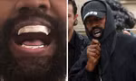 Kanye West gây sốc khi nhổ hết răng thật