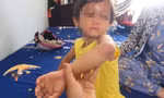 Làm rõ vụ bé gái 4 tuổi bị cha nuôi đánh gây thương tích 