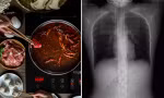 Một cô gái Trung Quốc ăn cay xong bị ho đến mức gãy 4 xương sườn, bác sĩ giải thích ra sao?