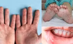 Tiếp xúc với bệnh nhân nghi mắc tay chân miệng, bé trai 2 tuổi tử vong