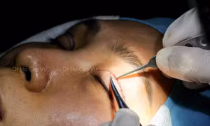 Thẩm mỹ 'chui' dùng người không bằng cấp tiêm filler, cắt mí trái phép cho khách