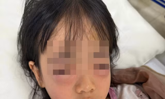Bé gái 5 tuổi nhập viện, mắt sưng vù sau khi chơi bong bóng xà phòng
