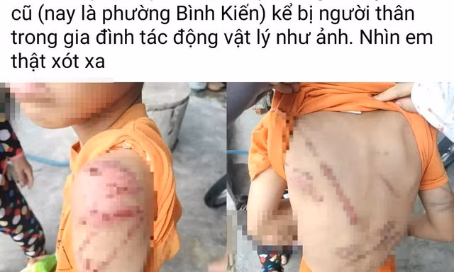 Công an vào cuộc vụ bé trai 10 tuổi ở Đắk Lắk chi chít vết thương gây xôn xao dư luận