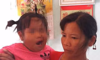 Bé 3 tuổi liệt dây thần kinh số 7 nghi do cô giáo đánh ở Thanh Hóa