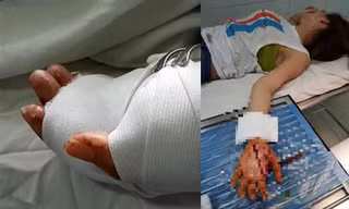 Bàn tay nạn nhân đã được bác sĩ băng bó