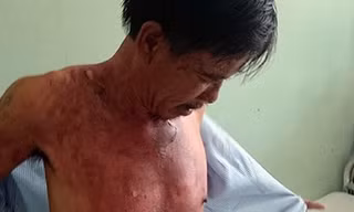 Nạn nhân Nguyễn Văn Lộc tại bệnh viện