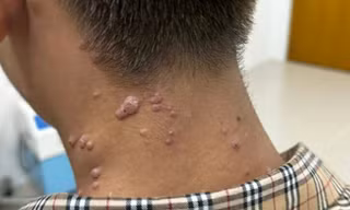  Đồng Nai: Nam thanh niên 17 tuổi nghi mắc đậu mùa khỉ 