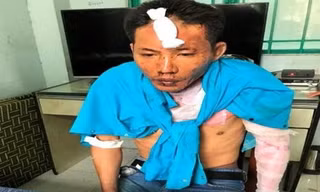 Nghi can Nguyễn Quang Dũng cũng bị bỏng nhẹ sau vụ việc