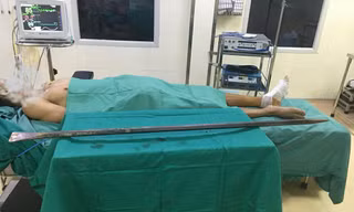  Bệnh nhân và chiếc xà beng đâm xuyên qua chân được các BS Bệnh viện E TƯ phẫu thuật lấy ra khỏi cơ thể.