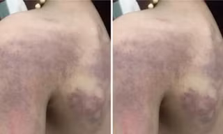 Làm rõ thông tin bé gái lớp 3 'bị giáo viên đánh bầm tím người'