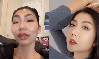 ‘Sốc’ nặng với siêu mẫu kỳ cựu khoe gương mặt sưng phồng vì mới đụng dao kéo