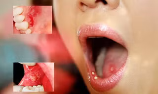 4 bệnh không nguy hiểm nhưng gây khó chịu trong mùa đông