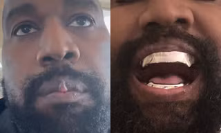 Gương mặt biến dạng của Kanye West sau khi nhổ hết răng