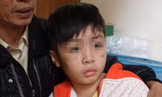 Cháu K. với nhiều vết sẹo trên mặt.