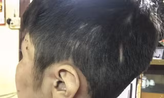 Trên khắp cơ thể bé K. (10 tuổi) chi chít những vết sẹo cũ lẫn mới chưa lành hẳn. Ảnh: Thanh Hà. 