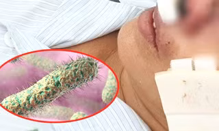 9 bệnh nhân mắc bệnh ‘vi khuẩn ăn thịt người’ Whitmore