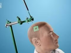 Sử dụng sóng siêu âm để chẩn đoán ung thư não