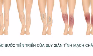 Nguyên nhân gây suy giãn tĩnh mạch chân