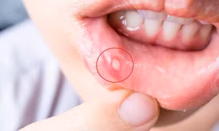 Thủ phạm gây nhiệt miệng