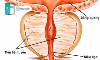 Có thể dự đoán tái phát ung thư tuyến tiền liệt sớm hơn 10 năm 