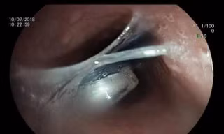 Người phụ nữ suýt chết vì 'chữa mẹo' lấy dị vật bị hóc