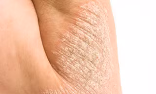 Bệnh vẩy nến cần dầu gội dành riêng