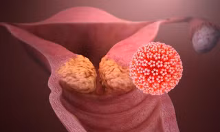 Hiểu về HPV - virus lây qua đường 'yêu' phổ biến nhất hiện nay