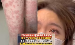 Nhuộm tóc liên tục suốt hai năm, cô gái ở Trung Quốc phải cạo đầu vì suy thận