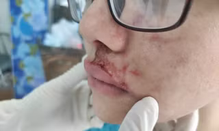 Tiêm filler tại thẩm mỹ viện có giá 3,5 triệu đồng/2 mũi, cô gái sưng phù khuôn mặt (ảnh: BVCC)