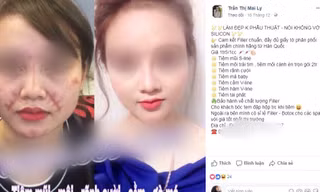 Tiêm filler: Sau công dụng 'thần tiên', làm nhanh giá rẻ là ẩn họa khôn lường!