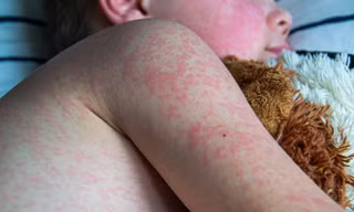 Những sai lầm nguy hiểm của cha mẹ khi chăm sóc con bị sởi khiến bệnh nặng thêm